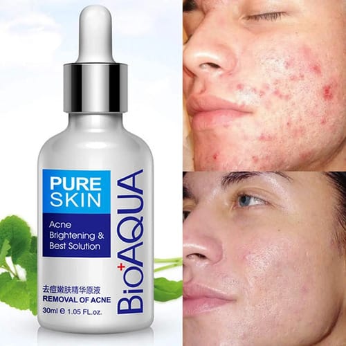 Suero Anti Acne Bioaqua 30ml - Ml Tipo De Piel Todo Tipo De Piel Día/noche