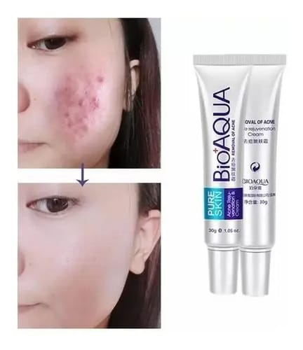 La Crema Secativa Para El Acné Bioaqua Elimina Las Cicatrices Del Acné Y Las Espinillas. Hora De Aplicación: Día/noche, Tipo De Piel Grasa