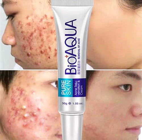 La Crema Secativa Para El Acné Bioaqua Elimina Las Cicatrices Del Acné Y Las Espinillas. Hora De Aplicación: Día/noche, Tipo De Piel Grasa