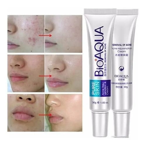 La Crema Secativa Para El Acné Bioaqua Elimina Las Cicatrices Del Acné Y Las Espinillas. Hora De Aplicación: Día/noche, Tipo De Piel Grasa