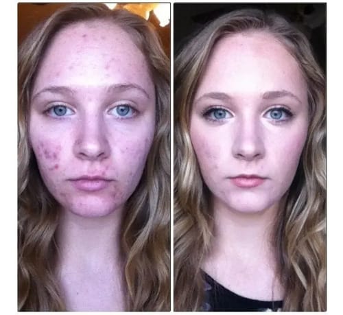 Mascarilla Facial Para Todo Tipo De Piel Bioaqua Acne Control Acne Remover, Suavizante Hidratante, 30 G Y 30 Ml