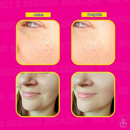 Kit Suero Vitam C+retinol+ac Hy Aplicación De Día/noche
