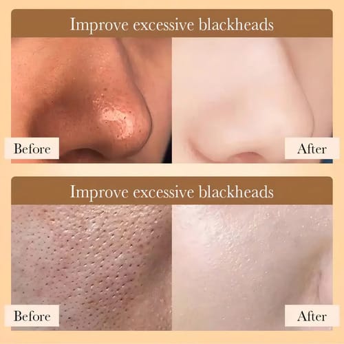 Mascarilla Stick Arroz Anti Acne Limpieza Profunda Bioaqua Tipo De Piel Mixta