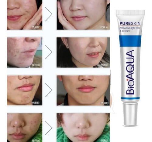 Crema Acne Cream Bioaqua Pure Skin Para Piel Grasa De 30g Grasa