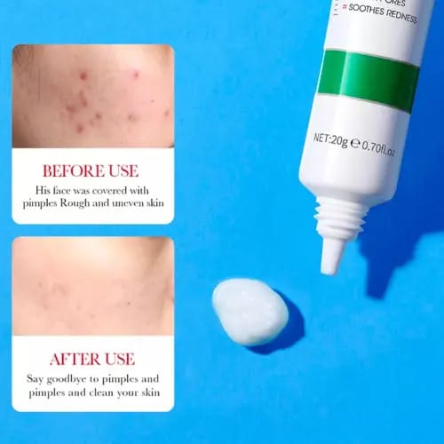 Crema Ácido Salicílico Bioaqua Control Acné Piel Grasa Grasa